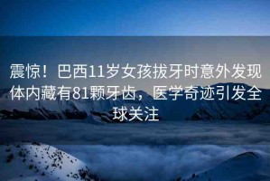 震驚！巴西11歲女孩拔牙時(shí)意外發(fā)現(xiàn)體內(nèi)藏有81顆牙齒，醫(yī)學(xué)奇跡引發(fā)全球關(guān)注